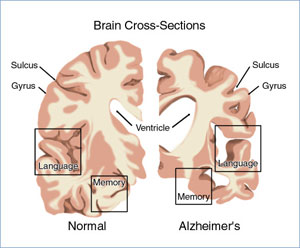 02alzheimers02-101